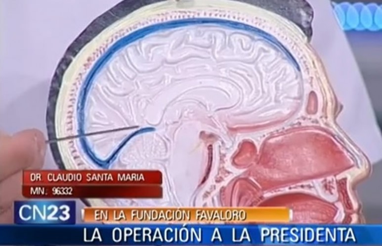 Dos especialistas explicaron cómo se recurepan los pacientes que pasan por el tipo de intervención quirúrgica al que fue sometida la jefa de Estado ¿Qué pasos deben seguirse?