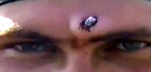 Le sacaron una bala de la frente