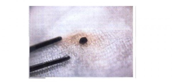 Los Extra�os casos de Implantes en Humanos