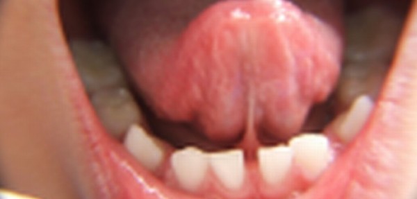 Deb�a cortar frenillo del pene a un nene, pero oper� el de la lengua