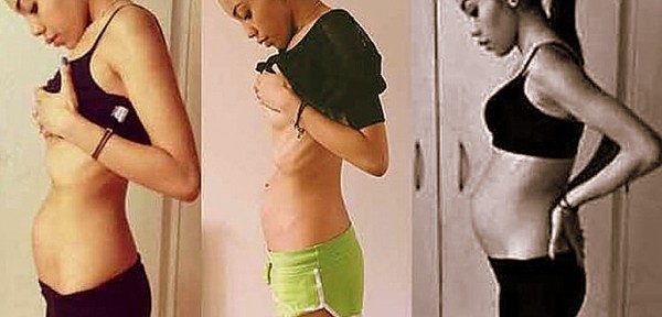 Anorexia: embarazada de casi nueve meses, pesa slo 51 kilos