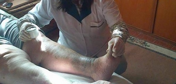 Una puntana dice que descubri� una crema que cura la psoriasis