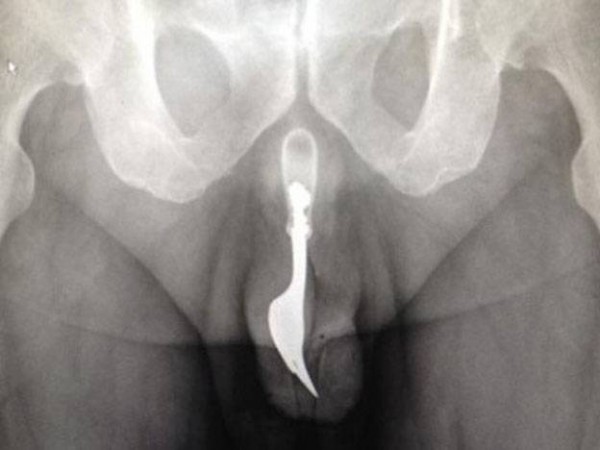 Radiografa: se clav un tenedor por placer