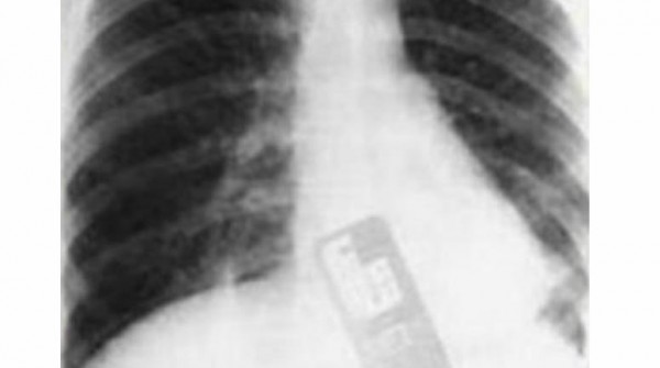 Es falsa la noticia que se dio a conocer hoy de la joven brasile�a que se trag� un celula