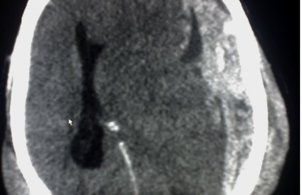 ¿Qué es un hematoma subdural crónico?