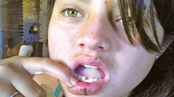 Le partieron el labio de un ladrillazo 