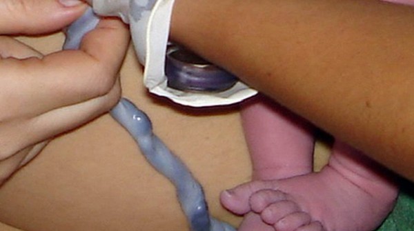 Un austr�aco recibir� un trasplante de m�dula con c�lulas de cord�n umbilical del Garrahan