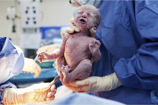 Aumento de n�mero de ces�reas genera preocupaci�n en las autoridades