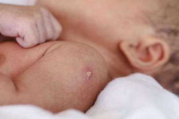 BCG: 100 a�os de la vacuna m�s antigua a�n en uso