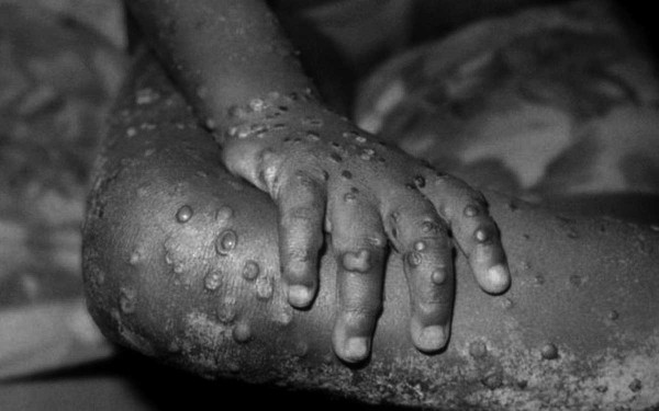 Alerta global por la viruela del mono: 6 preguntas clave sobre la Mpox respondidas por la OMS