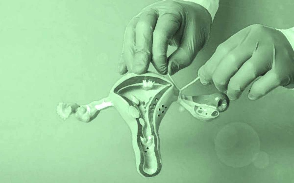 Mendoza: impulsan un proyecto que busca evitar embarazos a trav�s de ligadura de trompas y vasectom�a