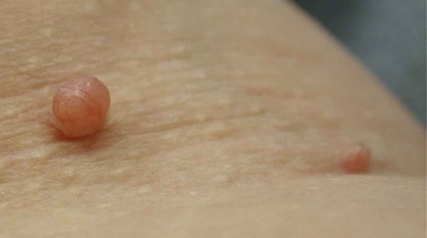 Dermatolog�a: qu� son los acrocordones, esas peque�as protuberancias que muchas veces se confunden con verrugas