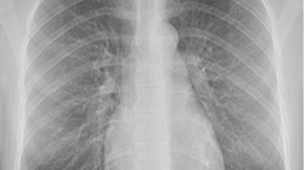 Una pastilla logra reducir a la mitad el riesgo de morir de un tipo de c�ncer de pulm�n