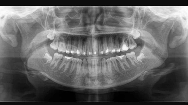 Un estudio científico revela que la causa del Alzheimer podría provenir de tu boca