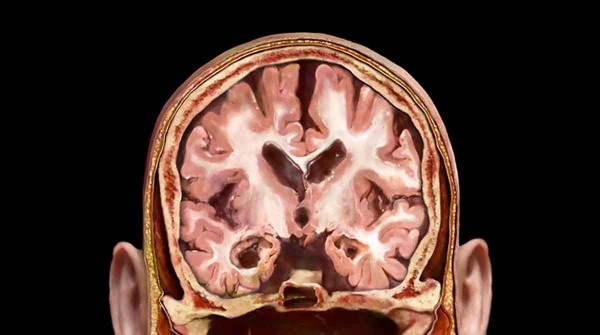 Riesgo de demencia vinculado al desequilibrio de protenas en la sangre en la mediana edad