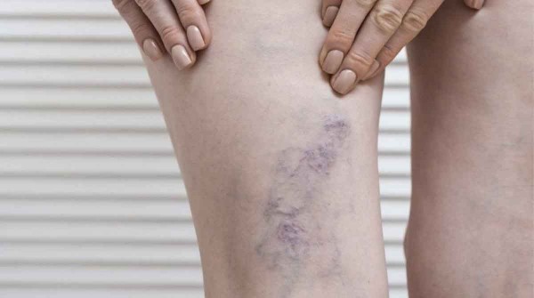 Desde várices a úlceras y trombosis: cómo prevenir y tratar la enfermedad venosa profunda