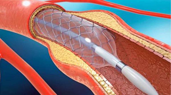 La crisis de los stent: los cardiólogos advierten que se agudizó el faltante y que “vamos a retroceder 50 años” en la atención del infarto