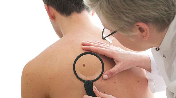 Cncer de piel: la vacuna argentina para el melanoma podra estar disponible a partir de marzo