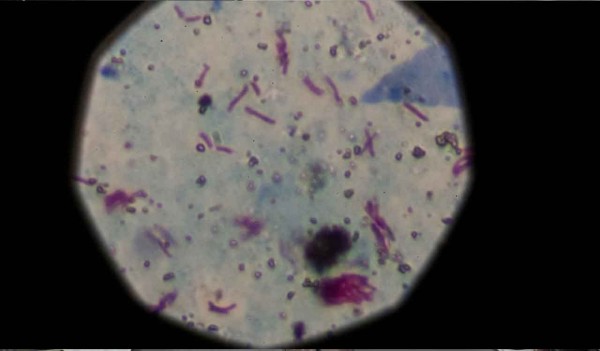 Preocupa una bacteria cuyo contagio no para de crecer y causa una muerte cada siete horas pese a tener cura