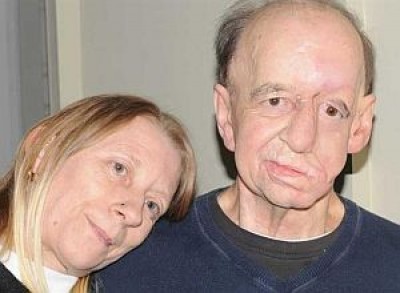 M�dicos imprimieron rostro y lo implantaron