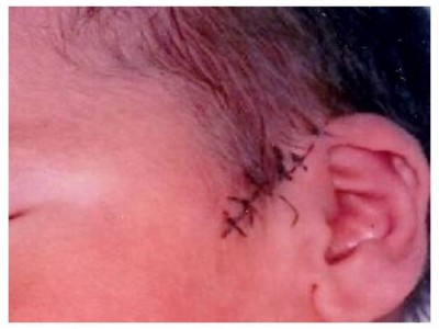 M�dicos cortaron con un bistur� en la cabeza a un beb� en una ces�rea